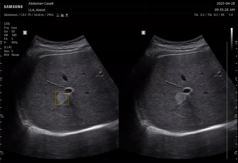 uterine