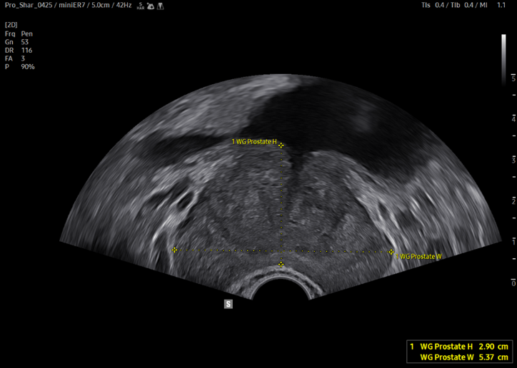 prostate