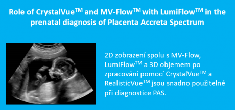 CrystalVue<sup>TM</sup> & MV-Flow<sup>TM</sup> pro vyšetření placenty