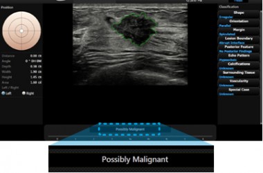 rs80_18_s-detect_breast